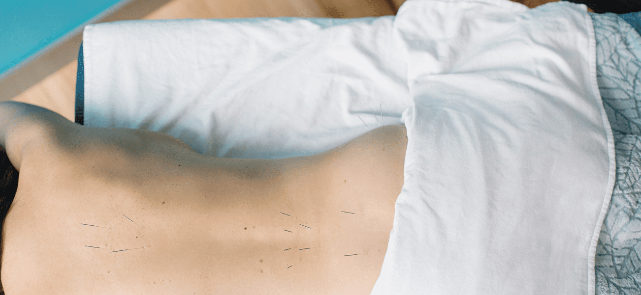 Acupuncture Services — Mind Body Soul Kelowna™